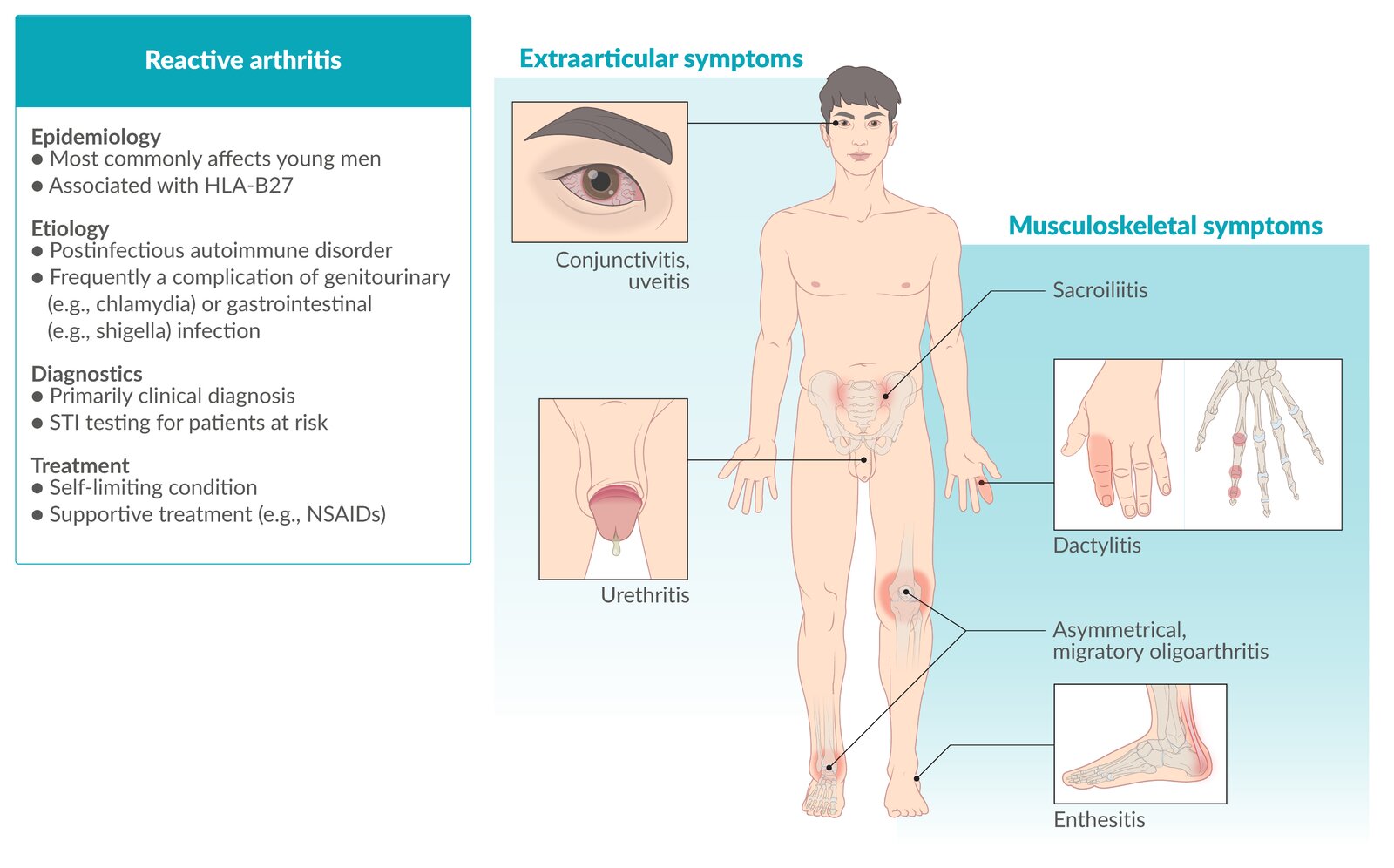 Artritis Reactiva Medical Gabeents