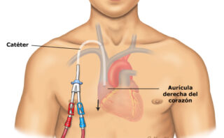 Tromboembolia pulmonar | CASO CLÍNICO