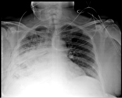 La imagen muestra una radiografía de tórax en vista anteroposterior. Se observa opacidad en el hemitórax derecho en la región basal, que sugiere la presencia de un derrame pleural, dado el patrón de opacidad homogénea y el desplazamiento de las estructuras pulmonares hacia la línea media.