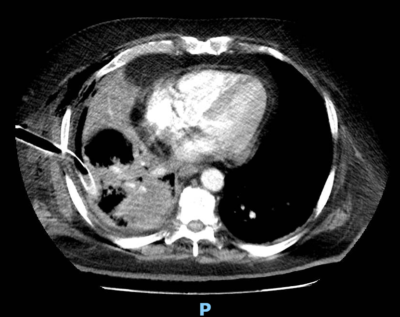 La imagen muestra una tomografía computarizada (TC) de tórax en un corte axial. Se observa  acumulación de líquido en el área pulmonar izquierda, que muestra densidades diferentes al tejido pulmonar normal. También se aprecia una sonda,  insertada para drenaje del derrame pleural