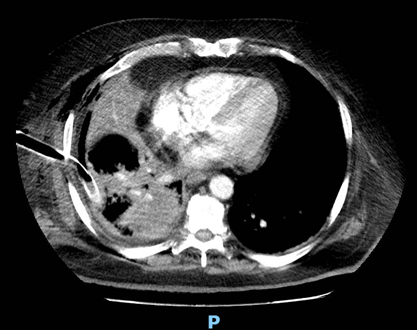 Caso clínico de tromboembolia pulmonar