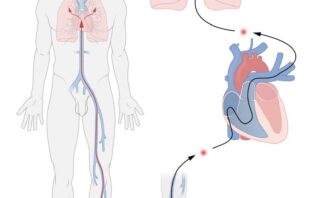 Infección de Acceso Vascular en Pacientes con Hemodiálisis