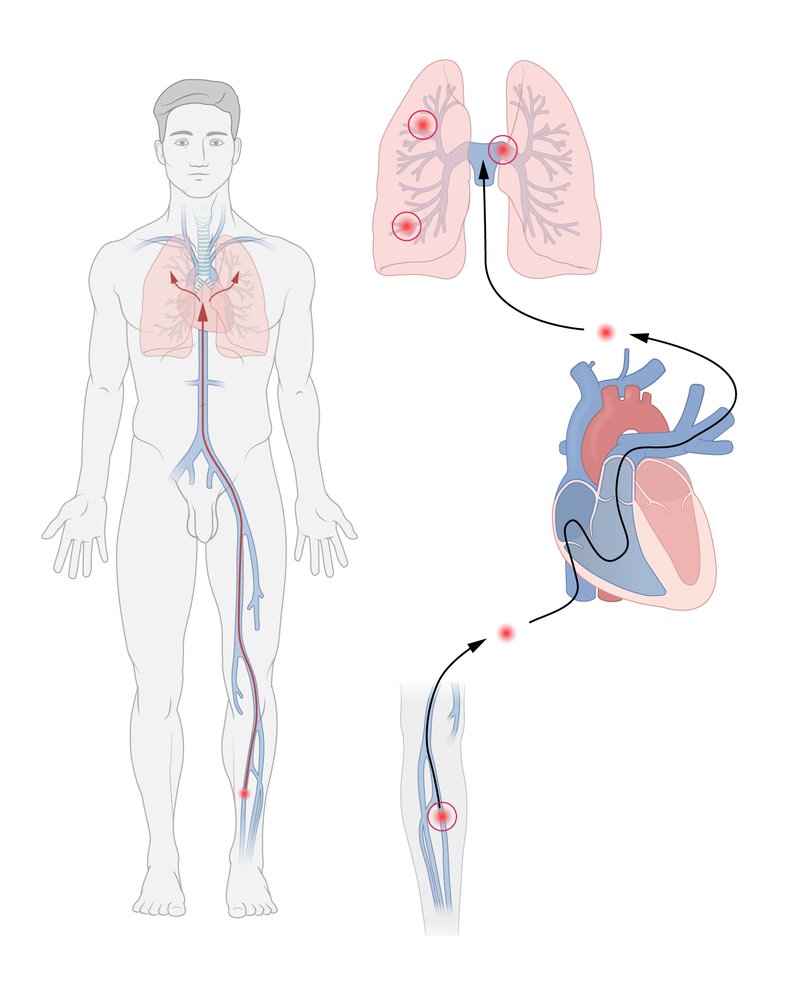 Embolia pulmonar: formación de trombos y embolización