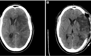 Artritis reumatoide