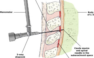 Dermatomiositis y polimiositis