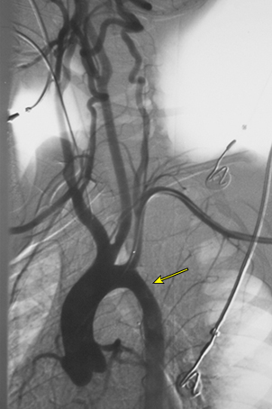 Una mujer de 13 años con aortitis Takayasu. El aortograma muestra estrechamiento tubular del istmo de la aorta (flecha).