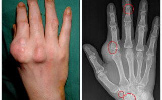 Dermatomiositis y polimiositis