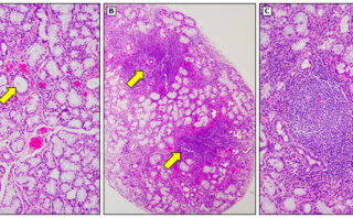 Arteritis de Takayasu | Características clínicas, y diagnóstico.