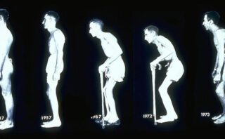 Antígeno leucocitario humano