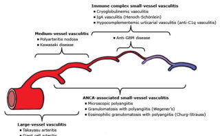 Espondiloartritis (SpA)