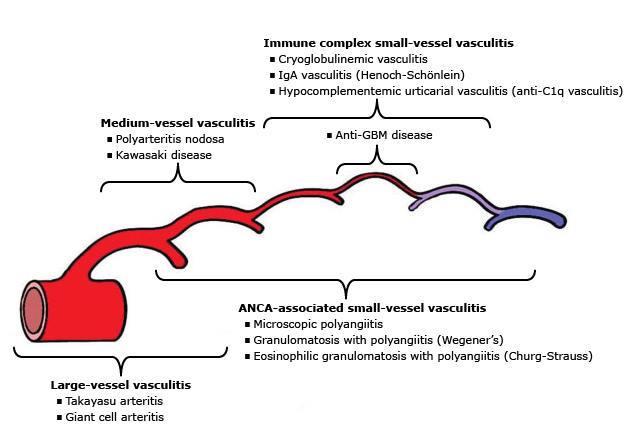 Tipos de vasculitis según el tamaño del vaso afectado, mostrando ejemplos de enfermedades asociadas a vasos grandes, medianos y pequeños, junto con subtipos específicos asociados a complejos inmunes y ANCA.