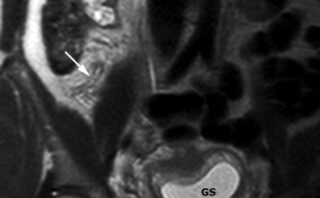 Pancreatitis aguda – Fisiopatología