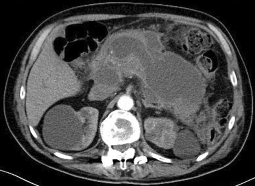 TC abdominal axial mostrando signos peripancreáticos compatibles con pancreatitis aguda.