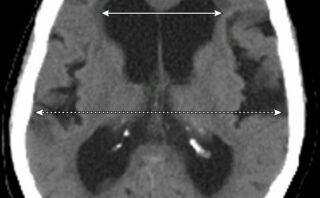 Neuromielitis óptica