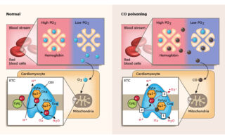 Anemia por inflamación