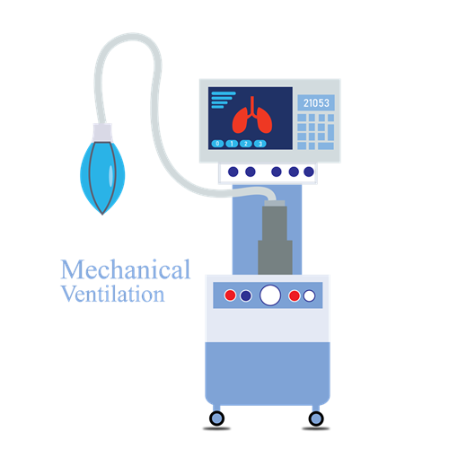 Ilustración de un ventilador mecánico utilizado en unidades de cuidados intensivos.