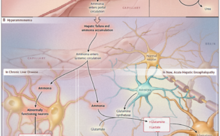 Preeclampsia