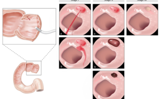 Cáncer de intestino delgado