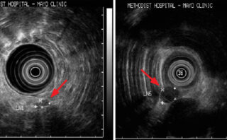 hipertensión arterial sistémica