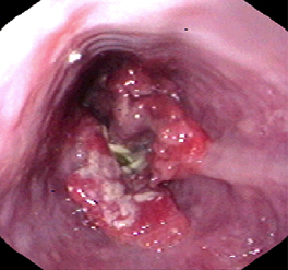 Masa esofágica maligna ulcerante en el esófago distal observada en la endoscopia.