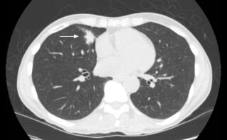 Derrame pleural