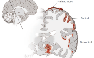 Preeclampsia