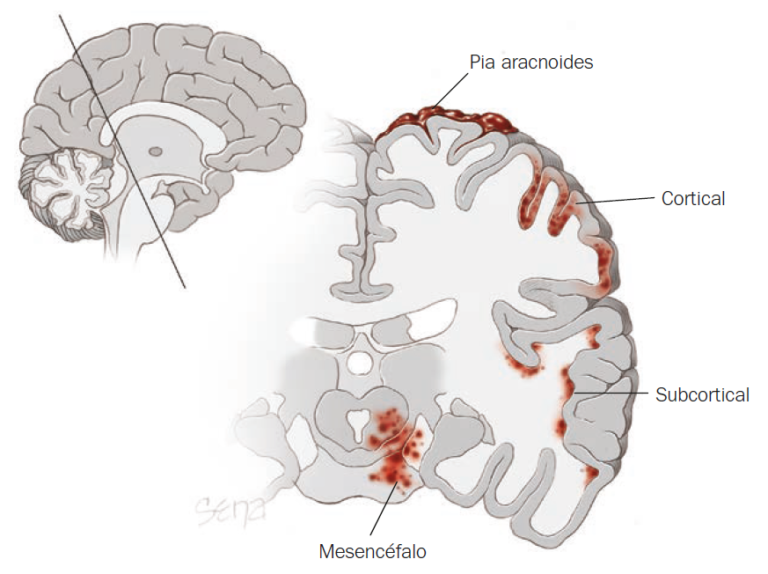 Eclampsia Medical & Gabeents