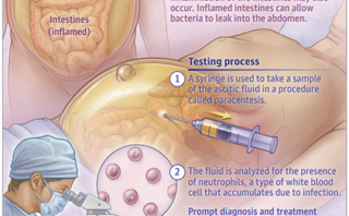 Enfermedad vascular cerebral | Acrónimo CAMALEON