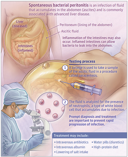 Esquema ilustrativo de la Peritonitis Bacteriana Espontánea (PBE), mostrando la acumulación de líquido ascítico, el procedimiento de diagnóstico mediante paracentesis y las opciones de tratamiento para esta infección asociada a la enfermedad hepática avanzada.