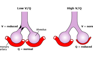 Encefalitis por Herpes simple