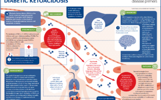 Esclerosis lateral amiotrófica ELA