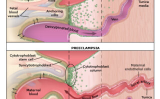 Eclampsia