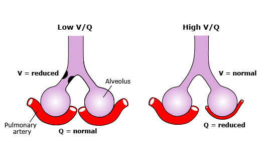 Desequilibrios en la Relación Ventilación-Perfusión (V/Q) en los Pulmones: En la izquierda, el esquema muestra una baja relación V/Q donde la ventilación está reducida y la perfusión es normal, asociado a enfermedades como neumonía. En la derecha, la imagen representa una alta relación V/Q con ventilación normal y perfusión reducida, característico del embolismo pulmonar.