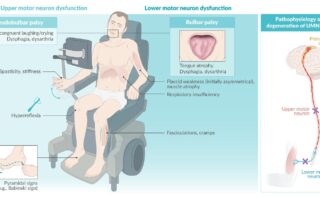 Cetoacidosis diabética