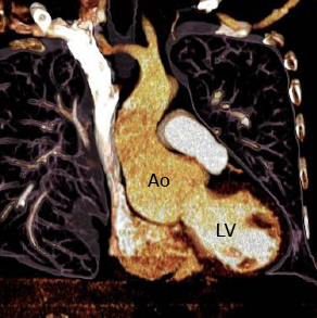 En esta vista coronal de TC, la raíz aórtica está dilatada al nivel de los senos de Valsalva.