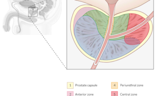 Infarto cerebral