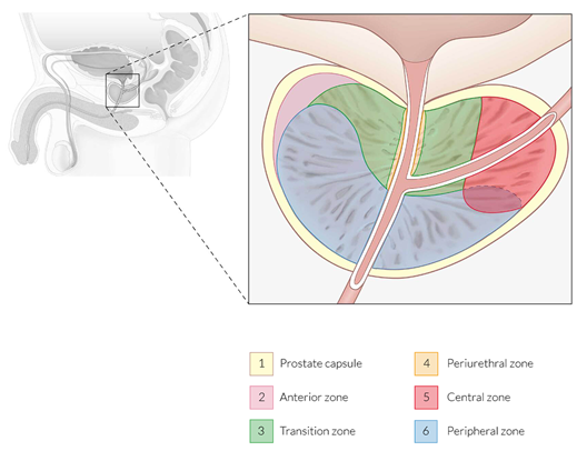 Ilustración anatómica de la próstata que muestra las zonas afectadas en la Hiperplasia Prostática Benigna (HPB). 