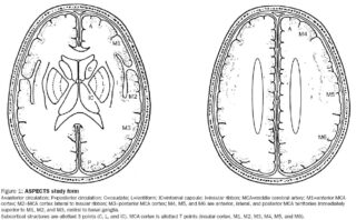 Infarto cerebral | Escalas pronósticas