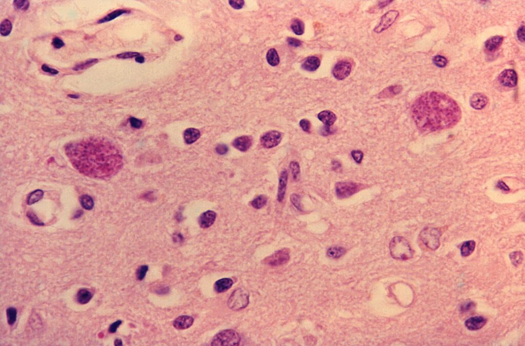 Toxoplasma gondii en tejido cerebral

