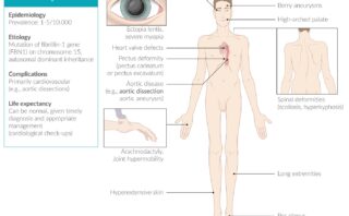 Toxoplasmosis