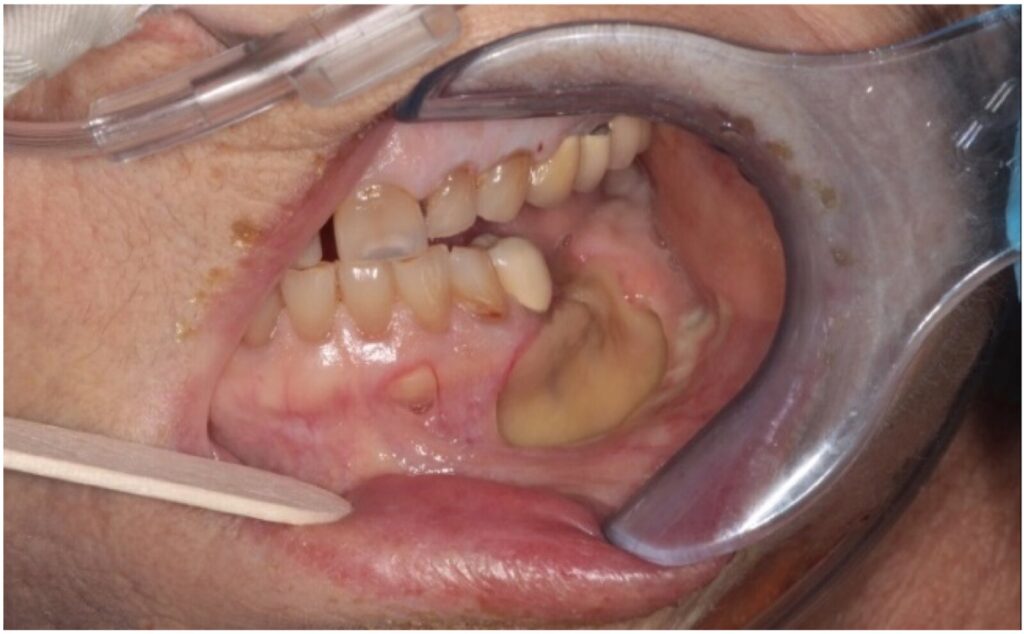 Osteonecrosis avanzada de la mandíbula relacionada con medicamentos