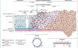 Colangitis esclerosante primaria