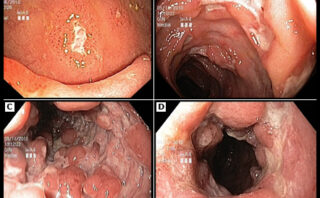 Infección urinaria complicada