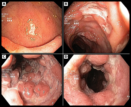 Hallazgos endoscópicos en la enfermedad de Crohn

