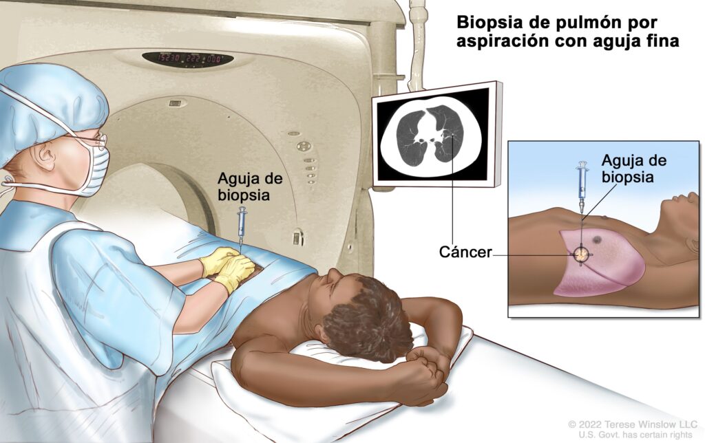 Biopsia guida por tomografía 
