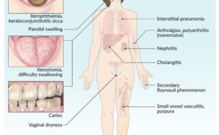 ¿QUÉ ES UNA BIOPSIA?