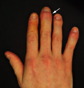 Distal interphalangeal joint involvement in psoriatic arthritis