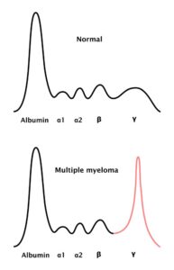 Mieloma múltiple: electroforesis de proteínas séricas con proteína M