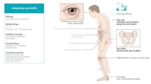 Ankylosing spondylitis