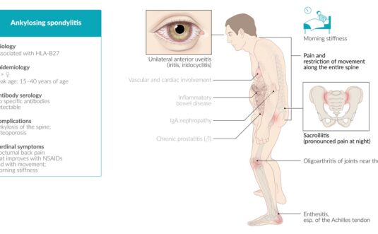 ARTRITIS REACTIVA